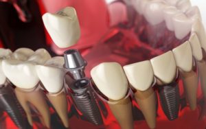 Разновидности имплантации зубов