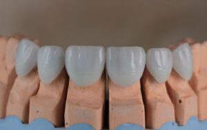 Металлокерамические протезы для зубов