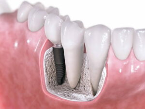 Протезирование зубов: показания и противопоказания