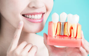 Имплантация зубов: разновидности зубных имплантов
