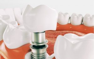 Имплантация зубов: этапы работы
