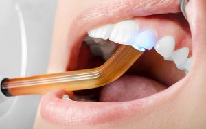 Восстановление зуба: как это сделать